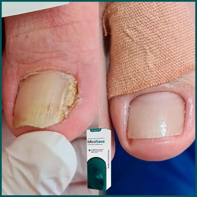 Micosave відгук 1