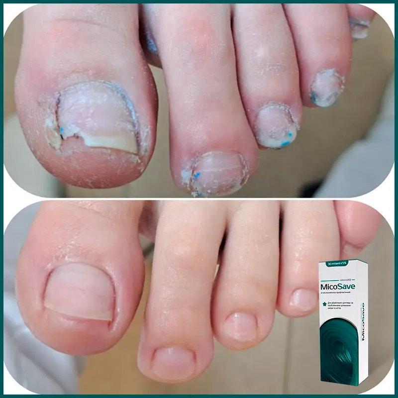 Micosave відгук 2